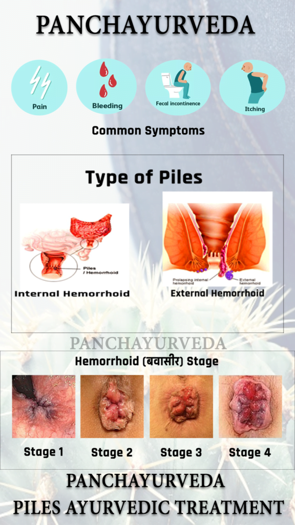 Symptoms Of Piles In Female Causes And Symptoms Of Piles In Female ZNLD