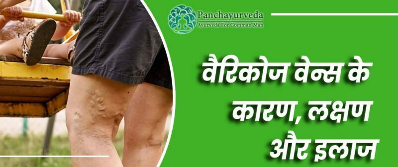 वैरिकोज वेन्स के कारण, लक्षण और इलाज